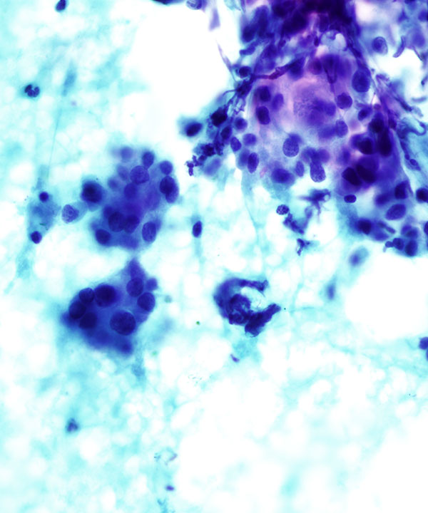 04 : Chronic Lymphocytic Thyroiditis