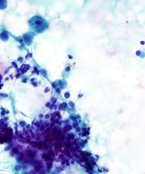 05 : Chronic Lymphocytic Thyroiditis