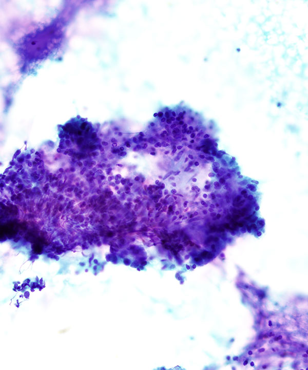 06 : Chronic Lymphocytic Thyroiditis