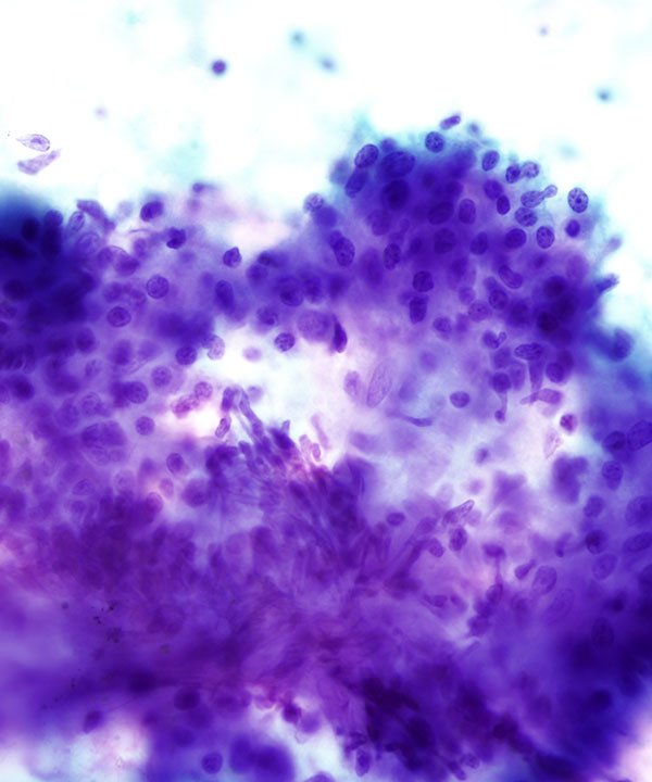 07 : Chronic Lymphocytic Thyroiditis