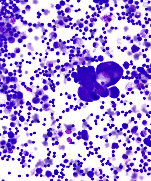 image showing 'Metastatic Lung Adenocarcinoma'
