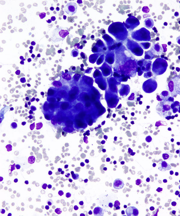 02 : Fluids Met Lung Adenocarcinoma