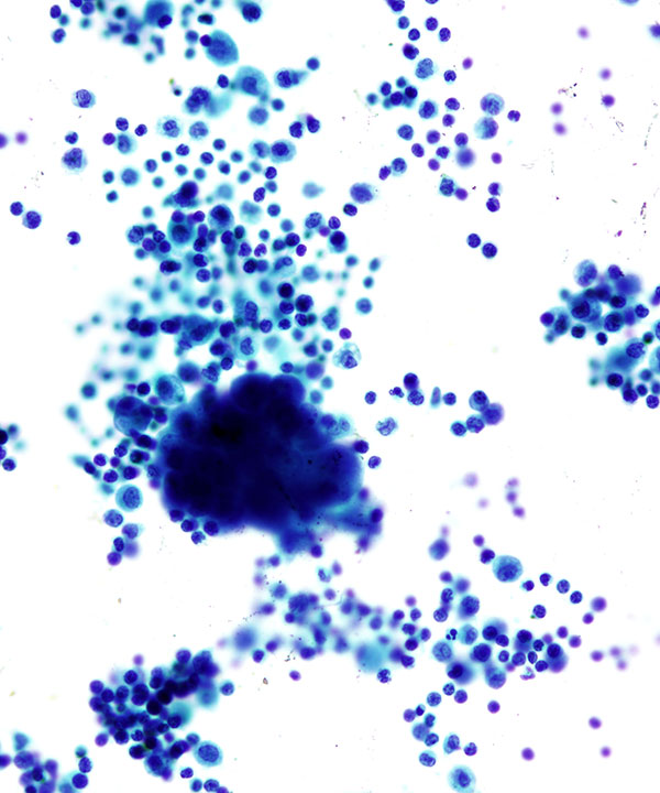 03 : Fluids Met Lung Adenocarcinoma