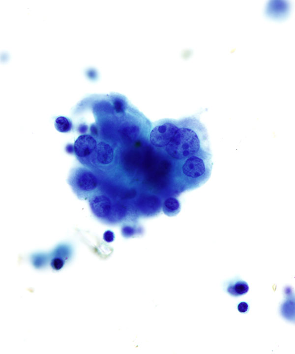 04 : Fluids Met Lung Adenocarcinoma