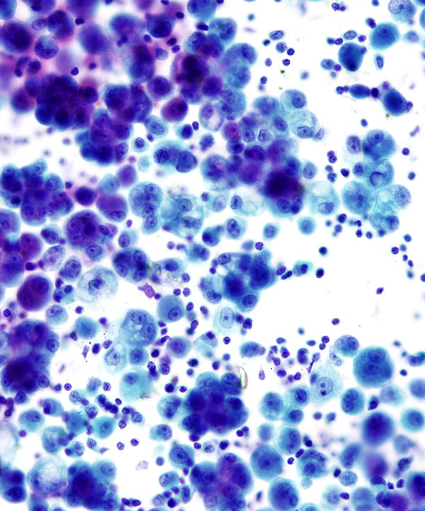 05 : Fluids Met Lung Adenocarcinoma