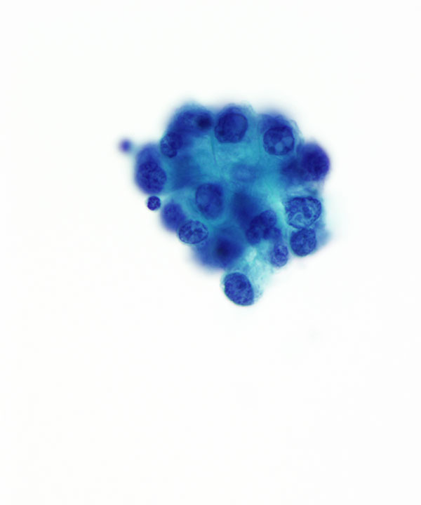 05 : Fluids Metastatic Breast Carcinoma