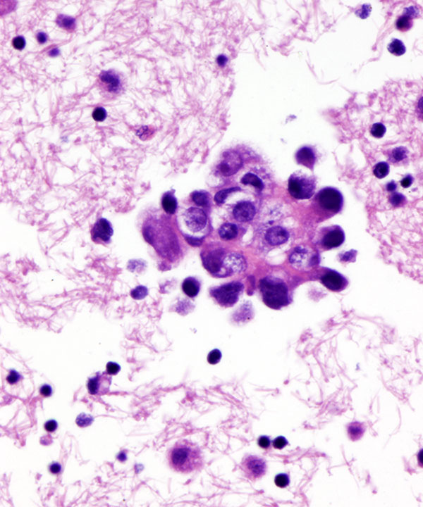 06 : Fluids Met Lung Adenocarcinoma