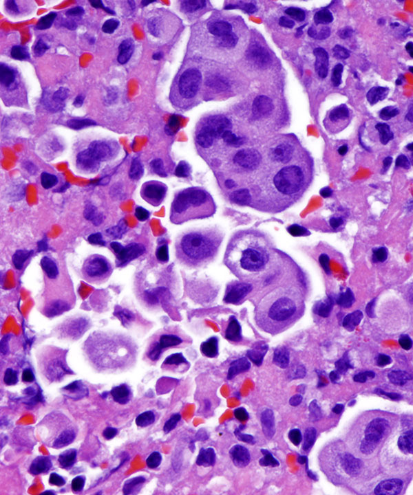 07 : Fluids Met Lung Adenocarcinoma