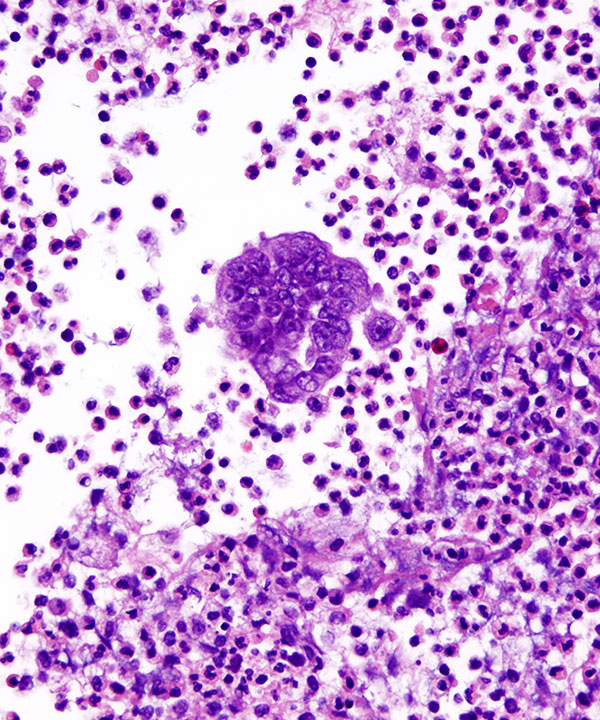 06 : Fluids Metastatic Breast Carcinoma