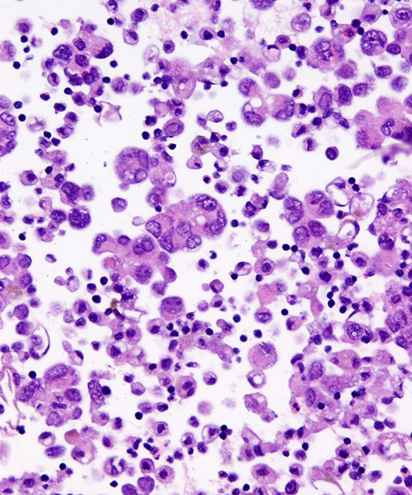 08 : Fluids Met Lung Adenocarcinoma