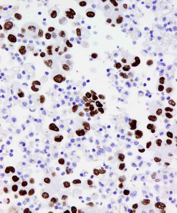 09 : Fluids Met Lung Adenocarcinoma