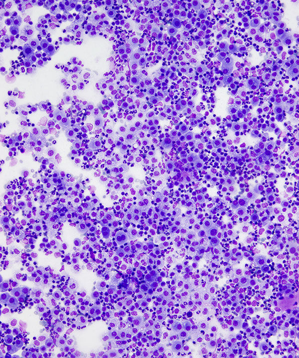 image showing 'Benign Effusion with Acute Inflammation'