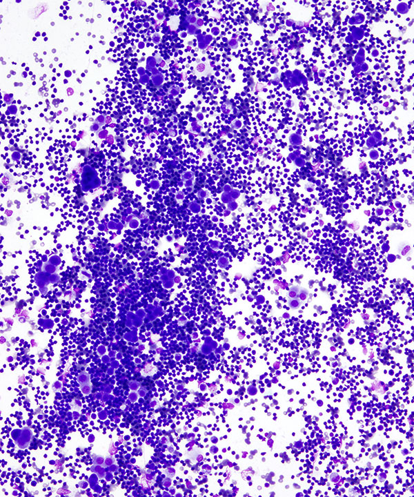 image showing 'Benign Lymphocytic Effusion'