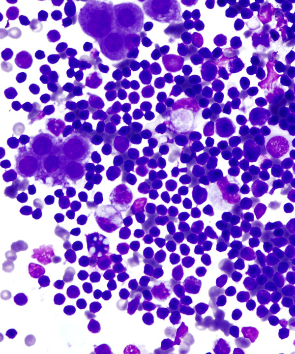 02 : Fluids Benign Lymphocytic Effusion