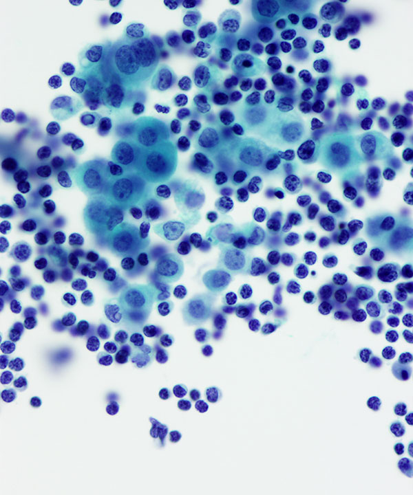 03 : Fluids Benign Lymphocytic Effusion