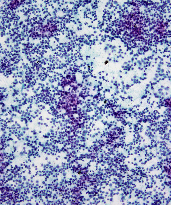 image showing 'Metastatic Melanoma'