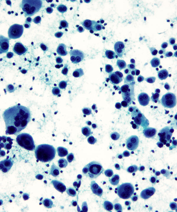 02 : Fluids Metastatic Melanoma