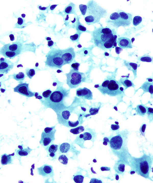 04 : Fluids Metastatic Melanoma