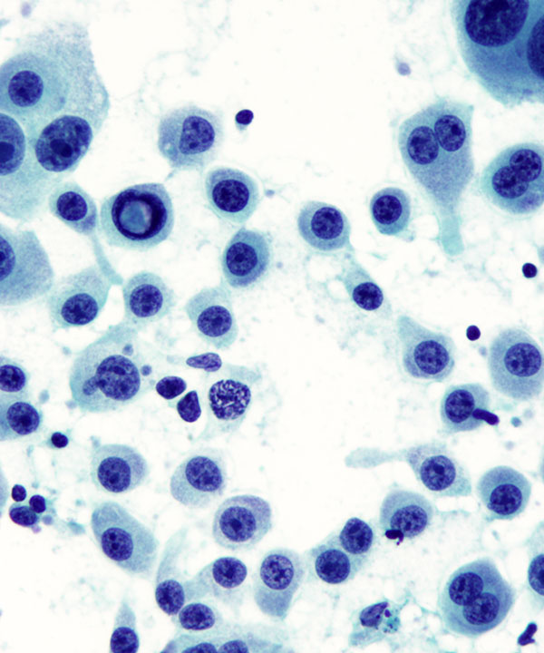 05 : Fluids Metastatic Melanoma