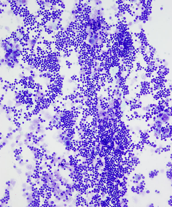 image showing 'Lymphoblastic Lymphoma'