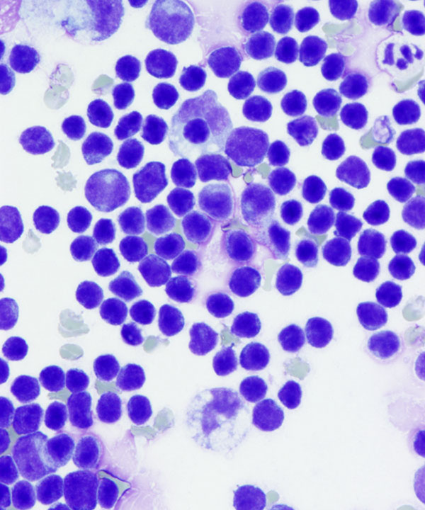 02 : Fluids Lymphoblastic Lymphoma