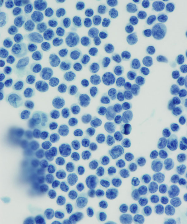 03 : Fluids Lymphoblastic Lymphoma