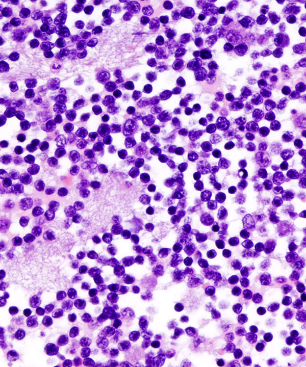 04 : Fluids Lymphoblastic Lymphoma