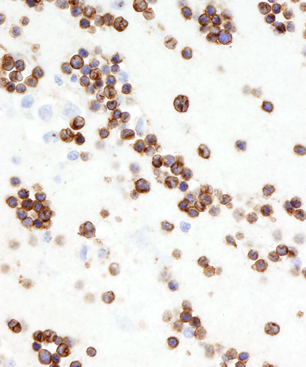 05 : Fluids Lymphoblastic Lymphoma