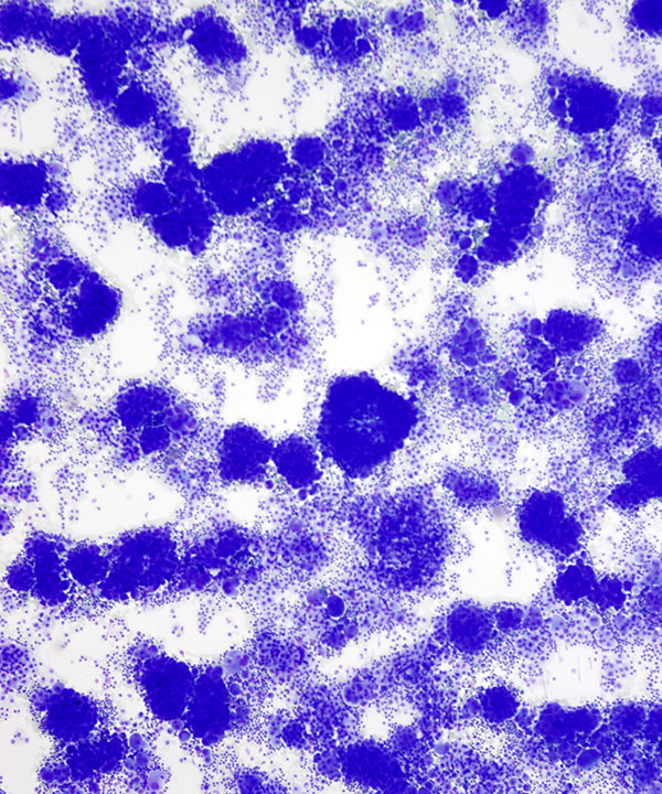 image showing 'Metastatic Mesothelioma'