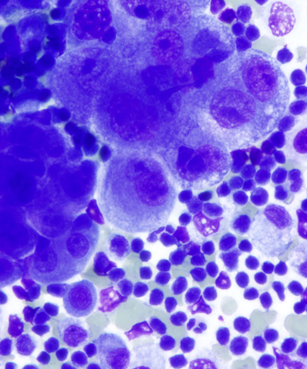 03 : Fluids Mesothelioma