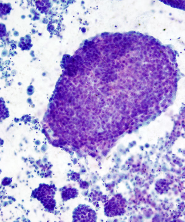 06 : Fluids Mesothelioma