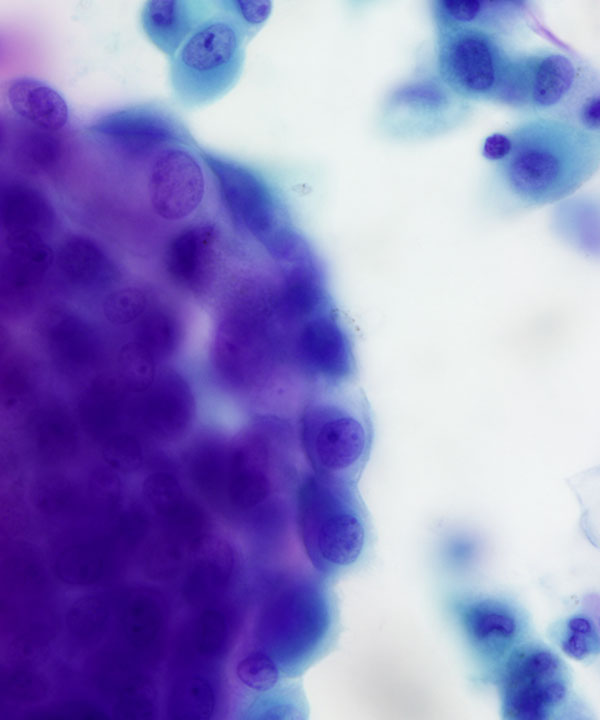 07 : Fluids Mesothelioma