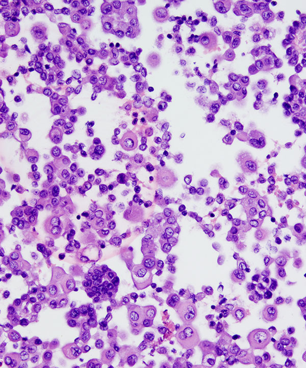 08 : Fluids Mesothelioma