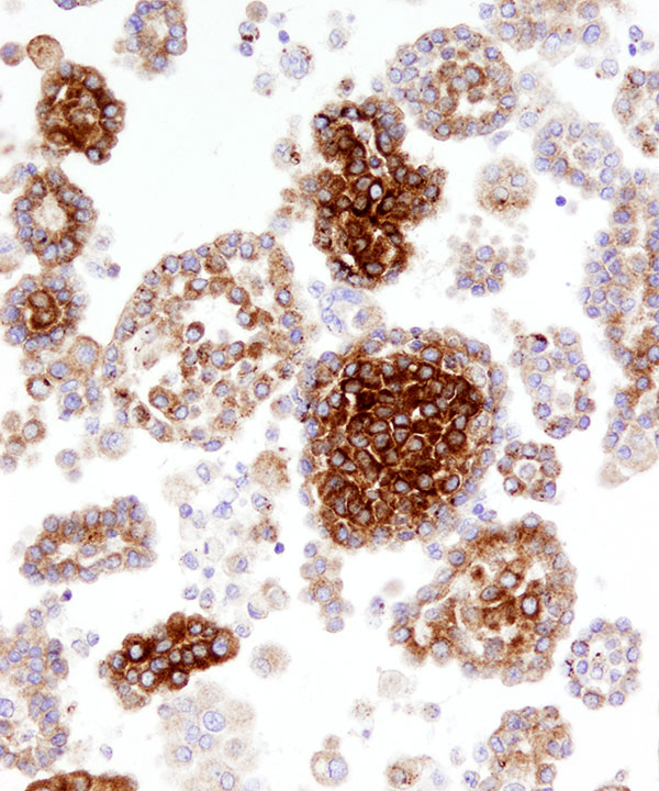 10 : Fluids Mesothelioma