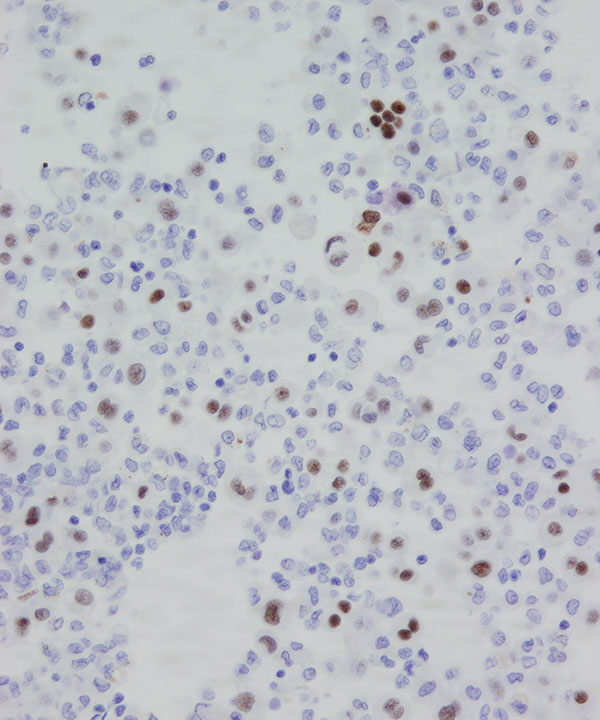 11 : Fluids Mesothelioma