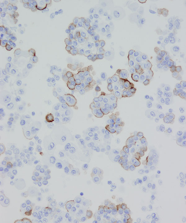 12 : Fluids Mesothelioma
