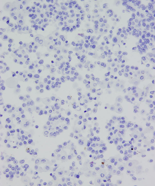 13 : Fluids Mesothelioma