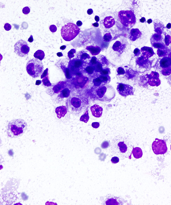 image showing 'Metastatic Endometrial Carcinoma'