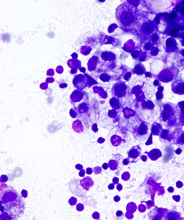 02 : Fluids Met Endometrial Ca
