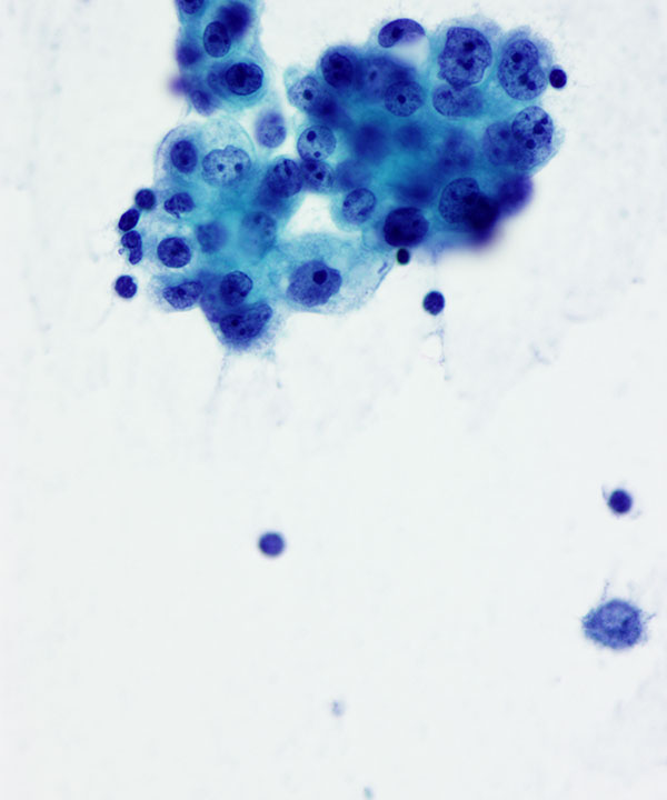03 : Fluids Met Endometrial Ca