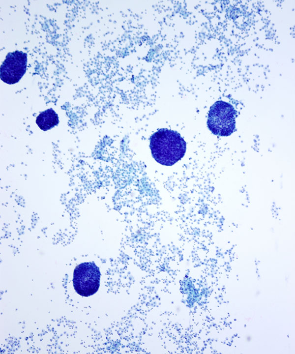 image showing 'Metastatic Breast Carcinoma'