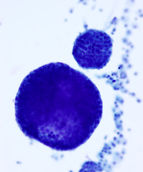 02 : Fluids Metastatic Breast Carcinoma