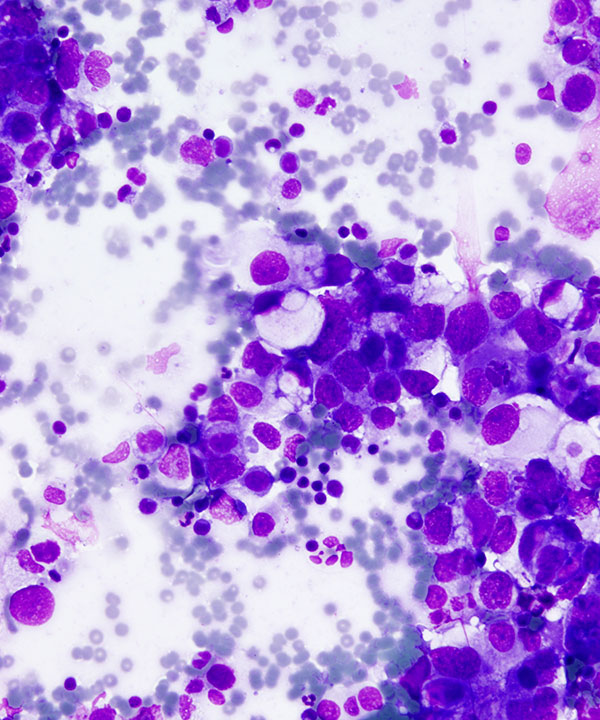 image showing 'Metastatic Gastric Carcinoma'