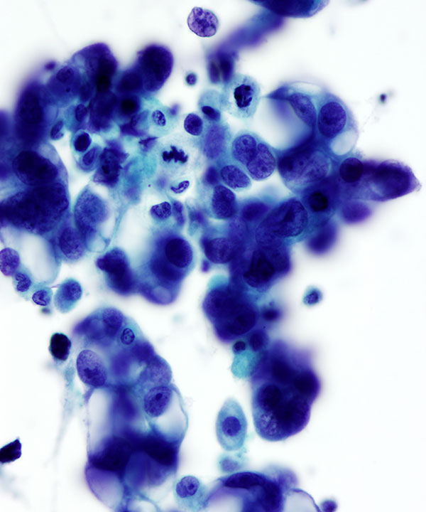 02 : Fluids Metastatic Gastric Carcinoma