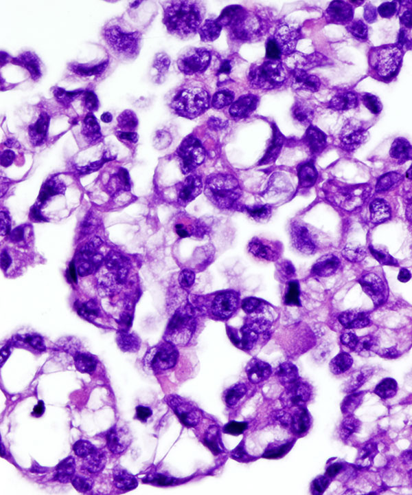 04 : Fluids Metastatic Gastric Carcinoma
