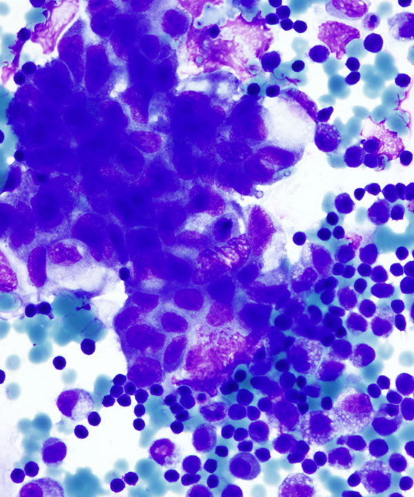 02 : FluidsMetastatic Serous Ca