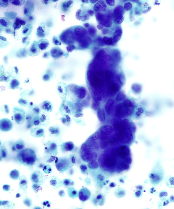 05 : FluidsMetastatic Serous Ca