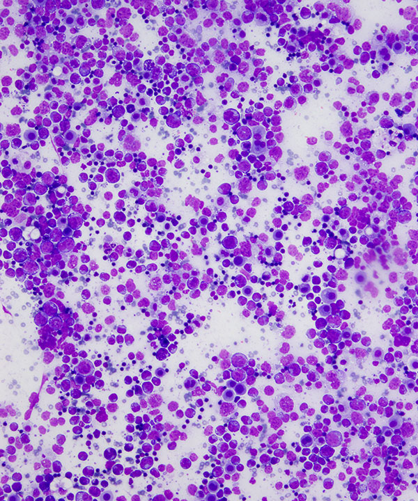 image showing 'Primary Effusion Lymphoma'
