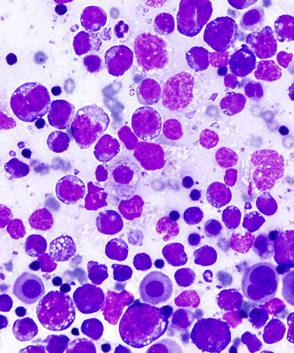 02 : Fluids Prim Eff Lymphoma