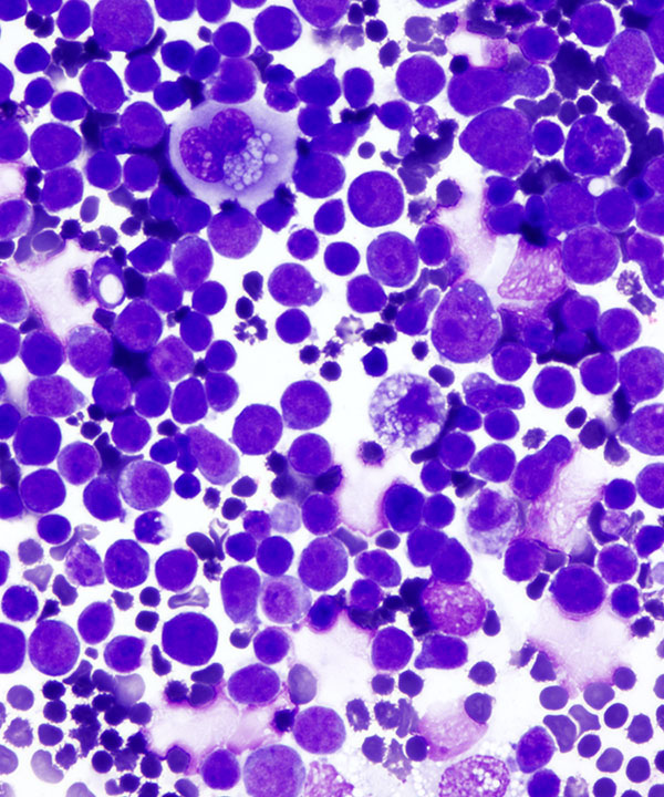 03 : Fluids Prim Eff Lymphoma